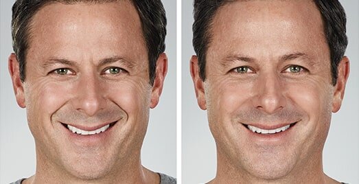 Dermal+Fillers+Before+and+After+NLF+Male
