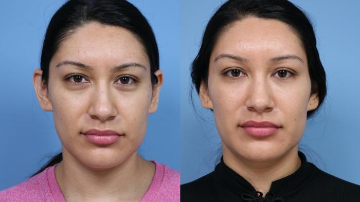 facial-fillers-191-front-thumbnail