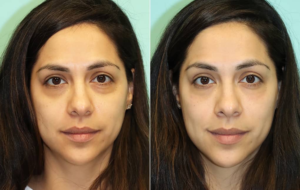 injections-before-after