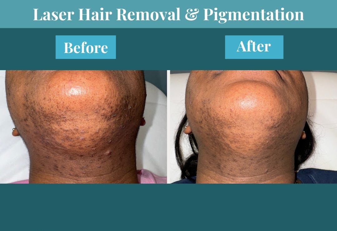 Before And After - Indulgence Aesthetics Wellness & Med Spa