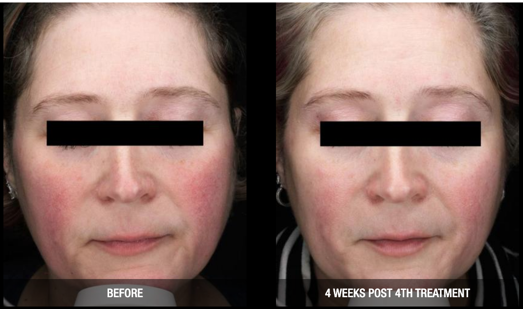 Nordlys-Light&Bright-Before-and-After (1)